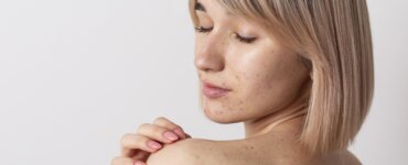 Fatores de risco do câncer de pele. | Foto: Freepik.